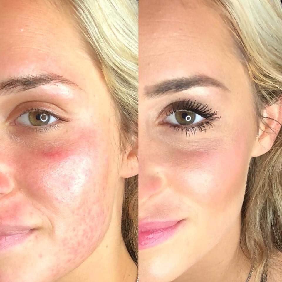 Contorno de ojos antes y despues